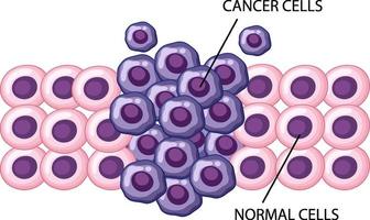 Prozess der Entwicklung von Krebszellen vektor