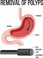 diagram som visar borttagning av polyper vektor