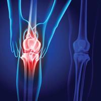 Röntgenbild von zwei Händen, die das Knie halten und eine Kniegelenksverletzung auf dunkelblauem Hintergrund zeigen.