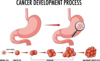 Diagramm, das den Krebsentwicklungsprozess zeigt vektor