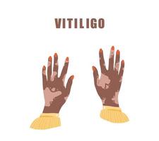 Afrikanische Frauenhände mit Vitiligo. Welt-Vitiligo-Tag. Hautkrankheit. Selbstfürsorge und Selbstliebe. vektorillustration im flachen karikaturstil vektor