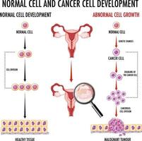 Diagramm, das normale und Krebszellen beim Menschen zeigt vektor