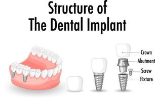 strukturen av tandimplantatet på vit bakgrund vektor