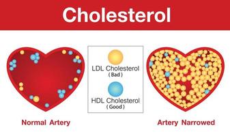 Cholesterin in der Arterie, Gesundheitsrisiko, Vektordesign. vektor