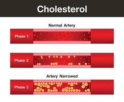 kolesterol i artären, hälsorisk, vektordesign vektor