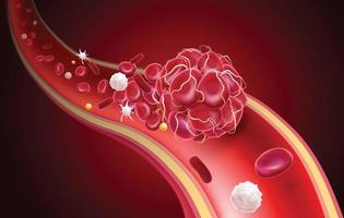3D-Darstellung eines Blutgerinnsels in einem Blutgefäß, das einen blockierten Blutfluss mit Blutplättchen und weißen Blutkörperchen im Bild zeigt.
