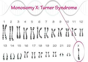 Turner-Syndrom Karyotyp Monosomie x vektor