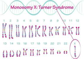 Turner-Syndrom Karyotyp Monosomie x vektor