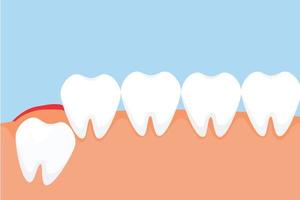 Ein Weisheitszahn bricht durch das Zahnfleisch und gibt ein rotes Schmerzsignalkonzept. gefährliche Weisheitszahnschmerzen verursachen Zahnfleischschmerzen. Zahn drückt von innen und verursacht Schmerzen am Zahnfleisch. vektor