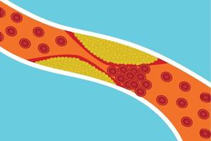 blodcirkulationskärlen blockeras av extra kroppsfett. röda blodkroppar blockeras av gult fett inuti en artär. mänsklig anatomi och blodkoagulering koncept vektorillustration. hjärtsjukdom. vektor
