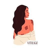 världsvitiligodagen. vacker kvinna med hudsjukdomen vitiligo. acceptans av ditt utseende, självkärlek. vektor illustration i platt stil
