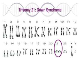 Karyotyp Trisomie 21 Down-Syndrom vektor