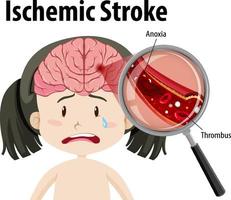 människa med ischemisk stroke vektor