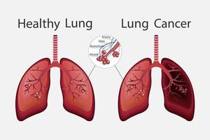 gesunde und ungesunde menschliche Lunge. normale Lunge versus Lungenkrebs. Ikone des menschlichen Organs. Vektor-Illustration. vektor