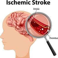 människa med ischemisk stroke vektor