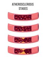 ateroskleros stadier vektor illustration på vit bakgrund. friska och ohälsosamma artärer. normala funktioner, endotelstörning, plackbildning, rupturtrombos.