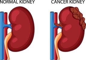 normal njure och cancernjure vektor