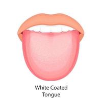 anatomi i munhålan. vektor illustration av tungan med vit beläggning.