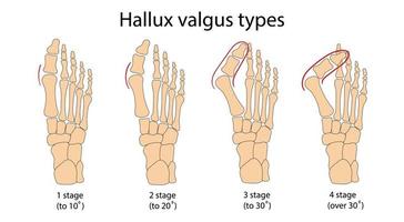 hallux valgus medicinsk infografik. vektor illustration.