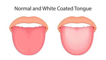 Anatomie der Mundhöhle. vektorillustration der zunge mit weißer beschichtung. vektor