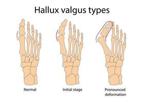 hallux valgus medicinsk infografik. vektor illustration.