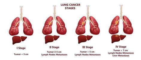 Lungenkrebs Stadien. Konzeptkrankheiten der inneren Organe des Menschen. Cartoon-Stil, Vektorillustration. vektor