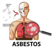 Diagramm, das Asbestose in der Lunge zeigt vektor