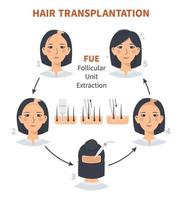 Stadien der Haartransplantation bei Frauen durch Extraktion der follikulären Einheit. Behandlung von Glatzenbildung, Alopezie und Haarausfall. Vektormedizinische Infografiken, eine weibliche Kopfhaut. Streifen, Pfropfmaschine. vektor