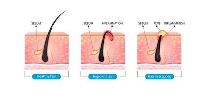 eingewachsenes Haar. Haare sind nach der Rasur wieder in die Hautoberfläche eingewachsen. Bildung von Hautakne oder Pickeln. Anatomie-Infografiken von Haar und Haut. auf weißem Hintergrund. 3D-Vektor-Illustration.