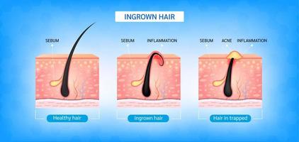 inåtväxande hår. hår har växt tillbaka in i hudytan efter rakning. bildning av hudakne eller finne. anatomi infografik av hår och hud. 3D vektorillustration. vektor