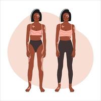 junge Afroamerikanerin mit Vitiligo. Menschen mit chronischer Hauterkrankung unterstützen. Schönheit ist Vielfalt. selbstakzeptanz, selbstliebekonzept. Vektor flache isolierte Illustration.