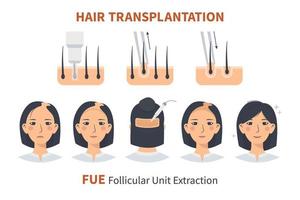 Stadien der Haartransplantation bei Frauen durch Extraktion der follikulären Einheit. Behandlung von Glatzenbildung, Alopezie und Haarausfall. Vektormedizinische Infografiken, eine weibliche Kopfhaut. Streifen, Pfropfmaschine. vektor