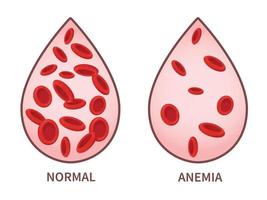 hemoglobin. anemi symptom, blodsjukdom. hälso-och sjukvård koncept. vektor