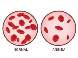 hemoglobin. anemi symptom, blodsjukdom. hälso-och sjukvård koncept. vektor