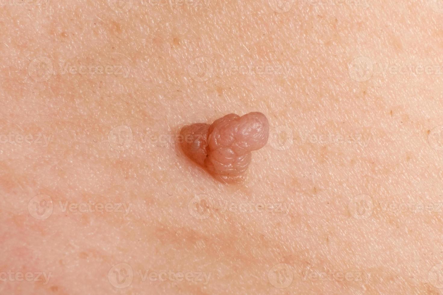 papillome cancéreux sur la peau, verrue en gros plan photo