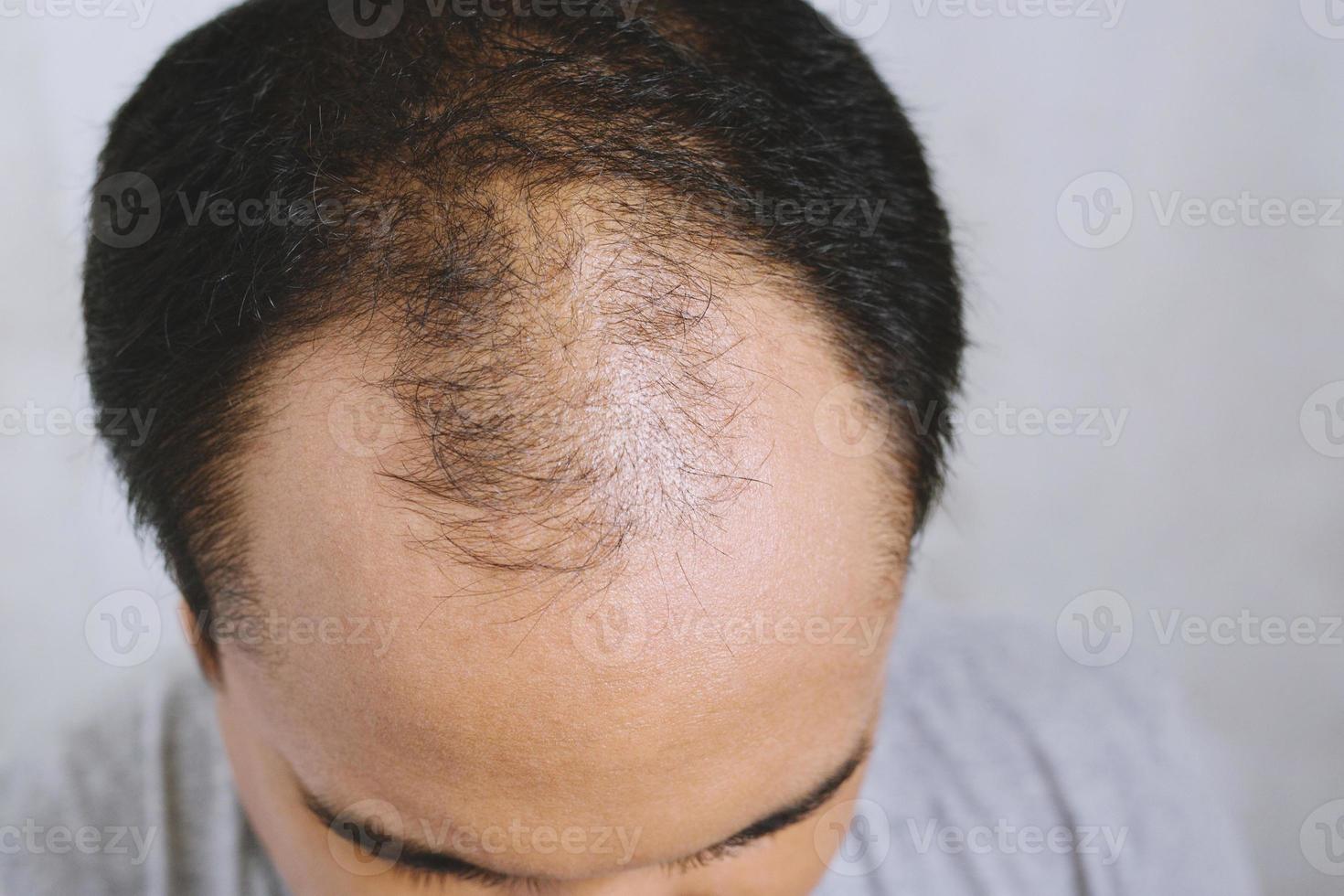 gros plan sur un jeune homme préoccupé par une grave perte de cheveux. tête chauve mince et cuir chevelu et cheveux cassés. concept soins de santé photo