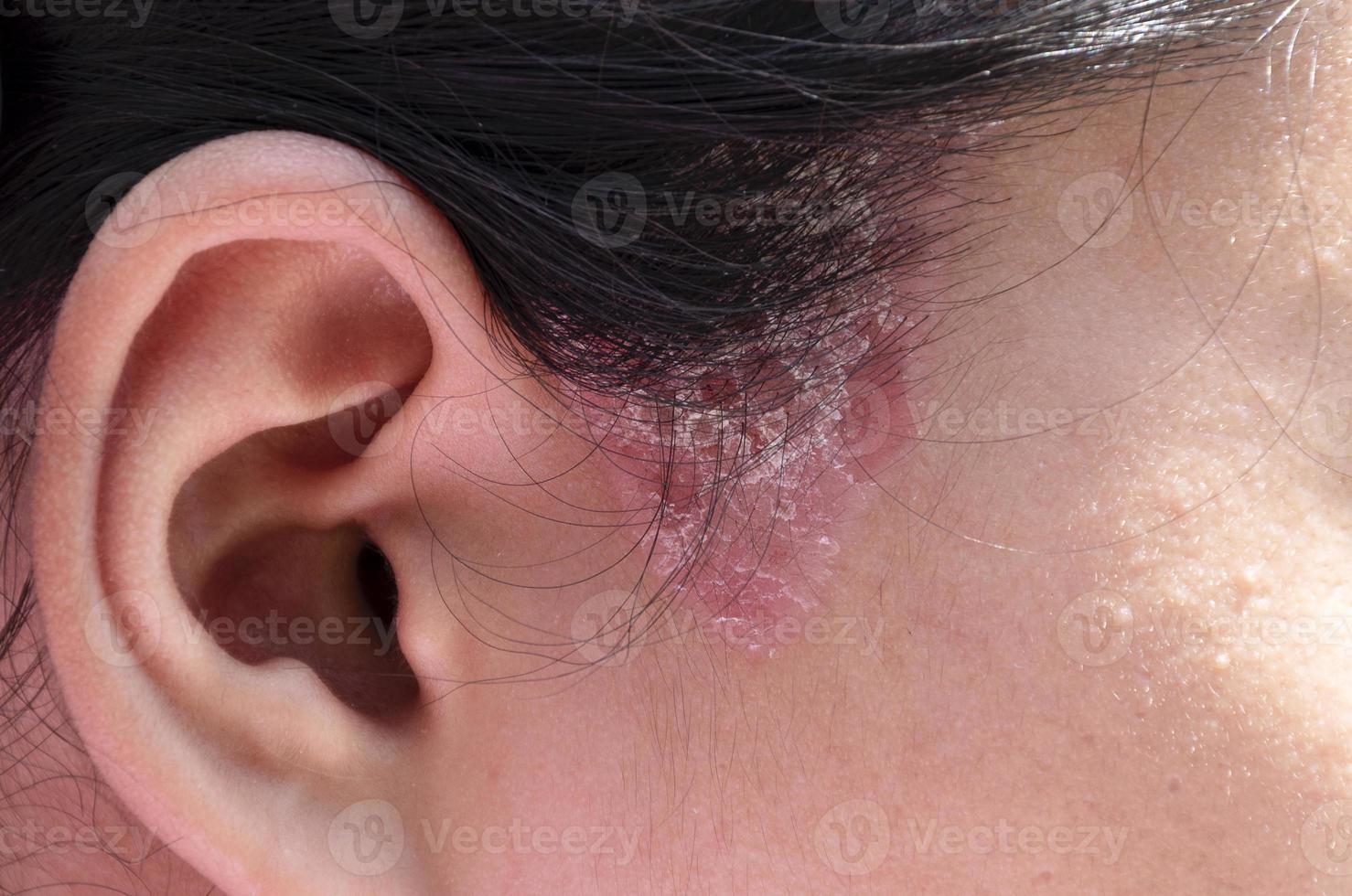 Close up sideburns girl a des lésions fongiques de la teigne photo