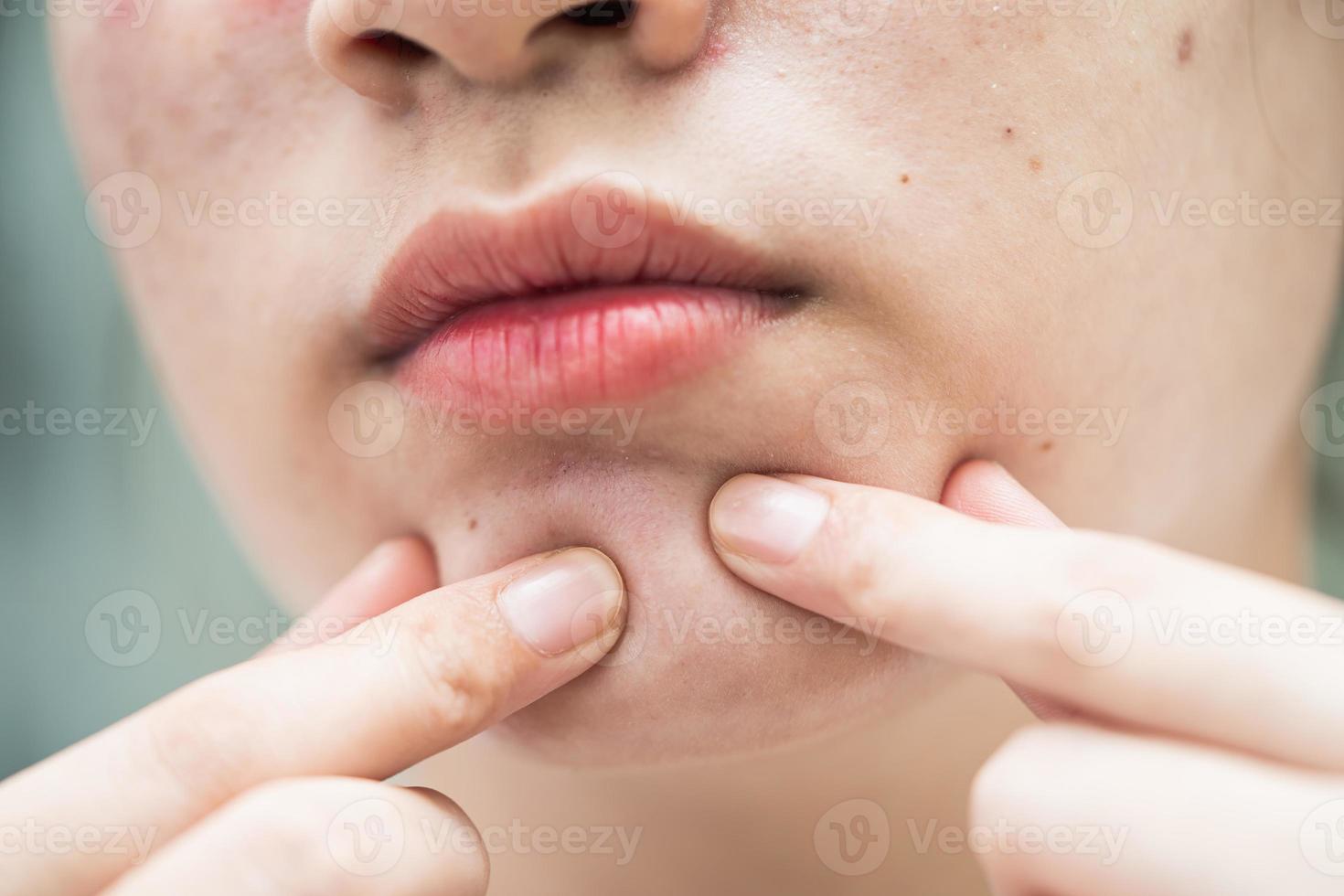 bouton d'acné et cicatrice sur le visage de la peau, troubles des glandes sébacées, problème de beauté des soins de la peau chez les adolescentes. photo