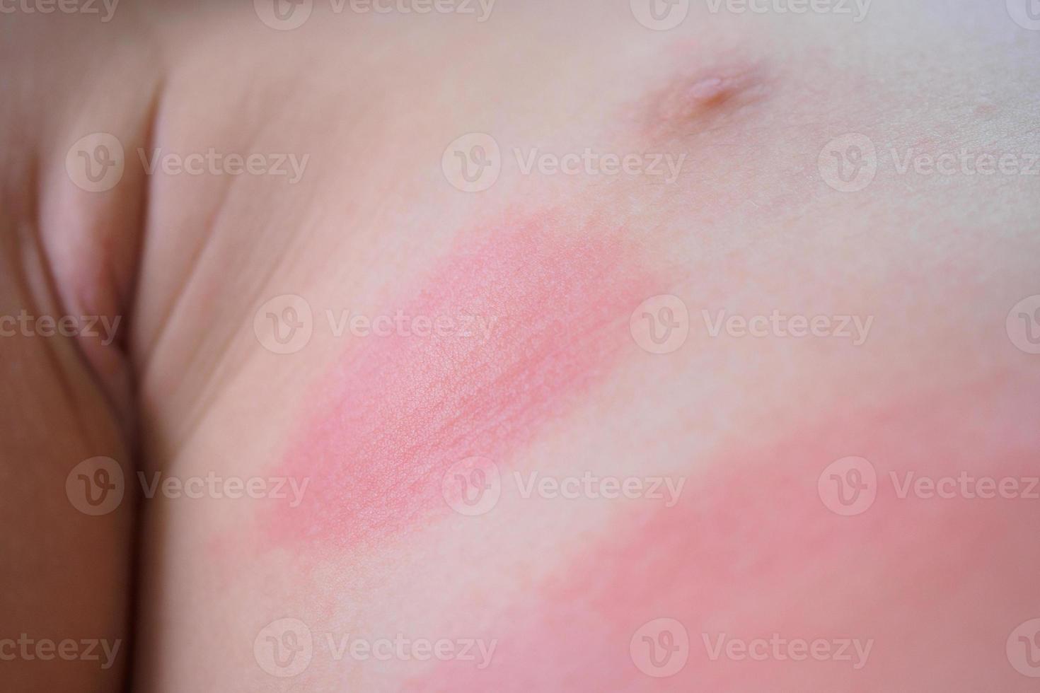 eczéma sévère éruption cutanée et symptôme de réaction allergique au petit corps d'enfant asiatique causé par une hypersensibilité photo