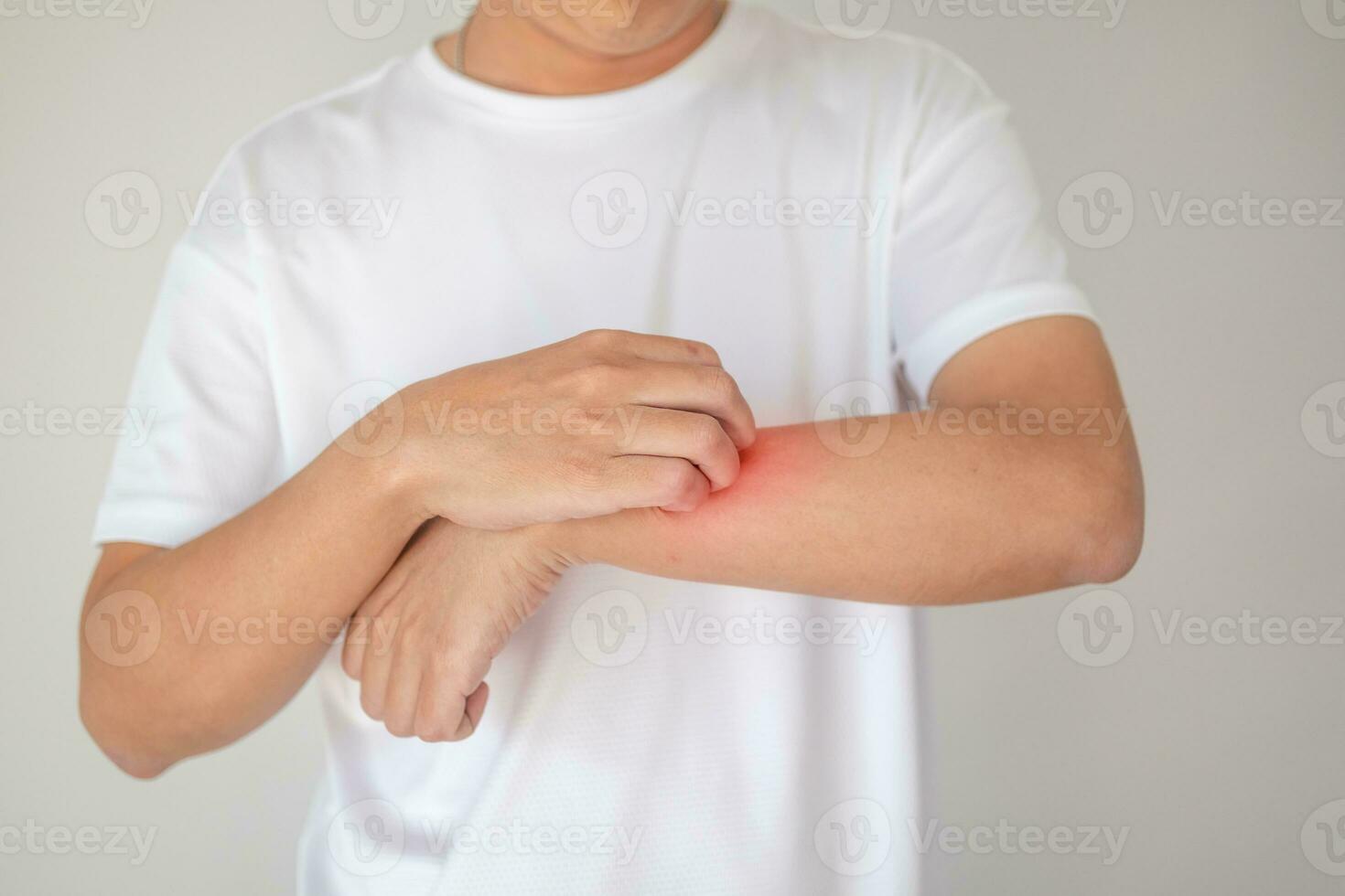 homme qui démange et se gratte le bras à cause de la dermatite de l'eczéma de la peau sèche qui démange photo