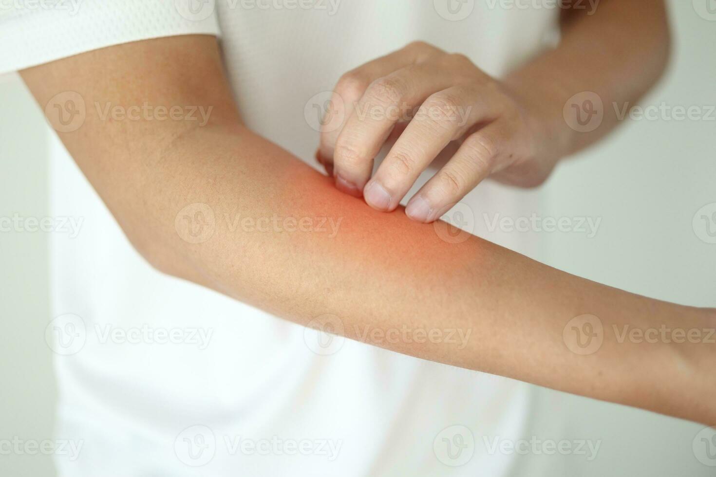 homme qui démange et se gratte le bras à cause de la dermatite de l'eczéma de la peau sèche qui démange photo