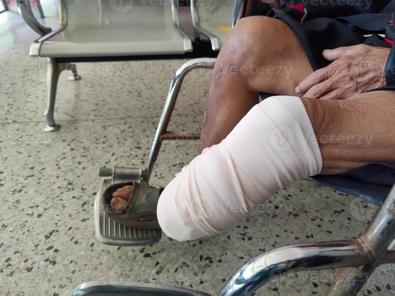 patient amputé sous le genou avec bandage élastique pour se préparer à la prothèse de jambe photo
