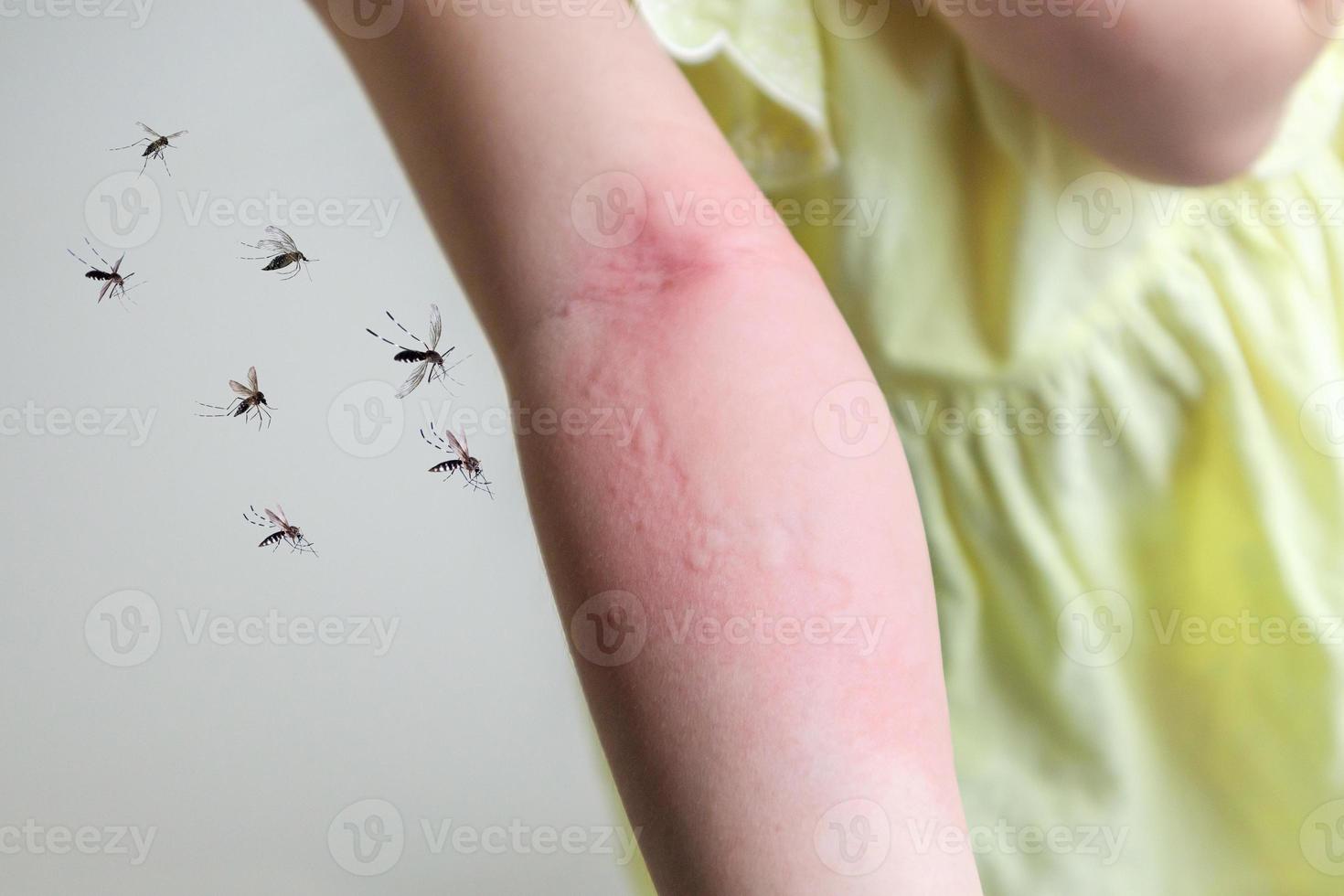 une petite fille a une allergie cutanée et des démangeaisons au bras à cause d'une piqûre de moustique photo