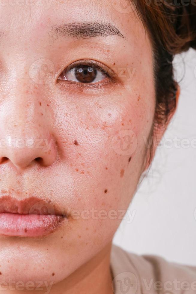 problèmes de santé de la peau des femmes avec des taches noires et des éruptions cutanées sur la moitié du visage photo