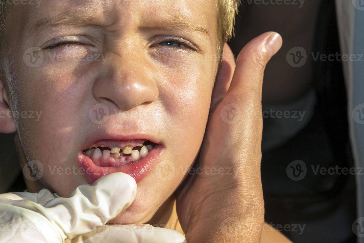 bouche ouverte d'un garçon avec des dents qui poussent mal, des caries de dents de lait, des dents de lait enlevées, de la dentisterie et des soins de santé photo