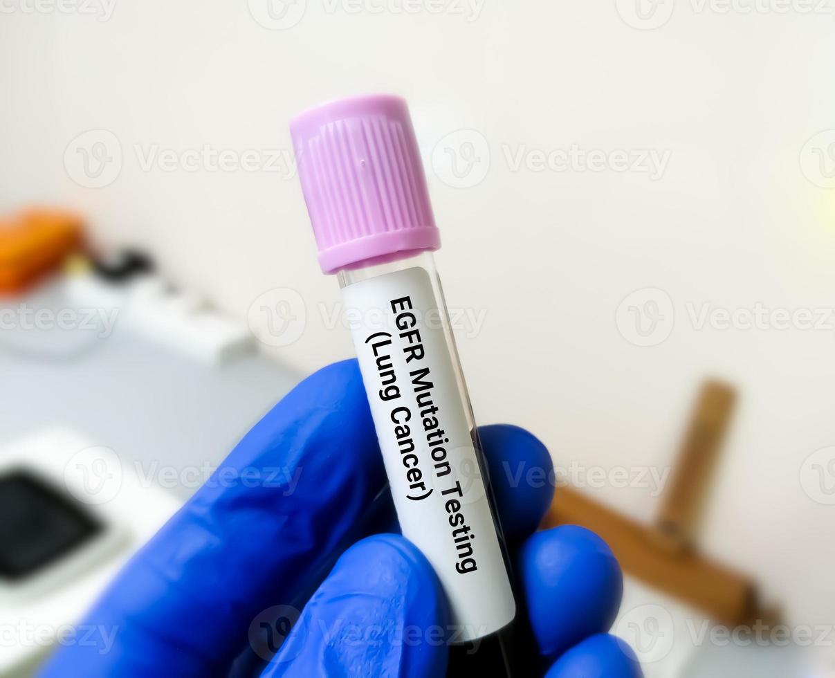 biologiste moléculaire détenant un échantillon de sang pour le test de mutation egfr pour le diagnostic d'une maladie pulmonaire. Récepteur du facteur de croissance épidermique. photo