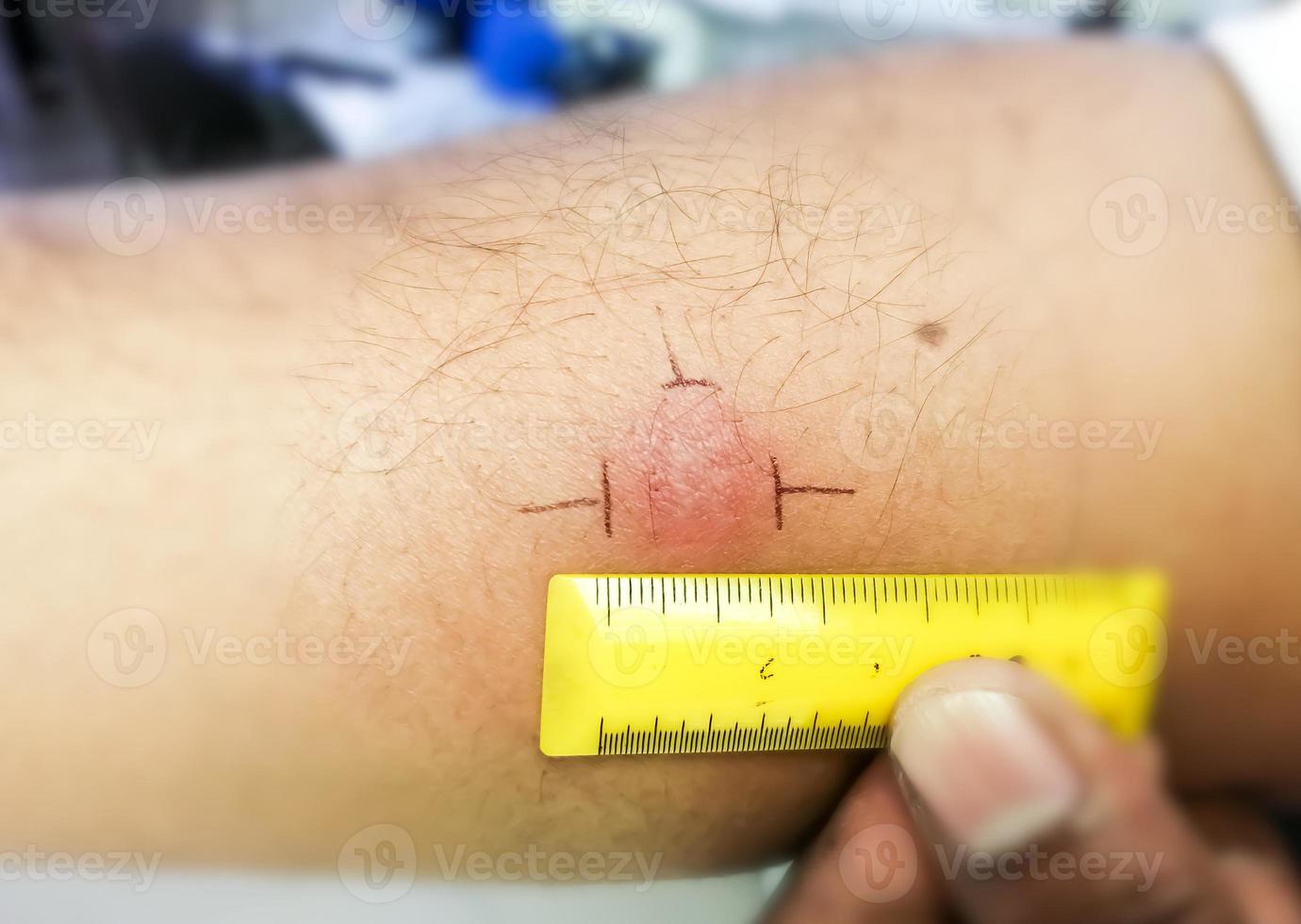 vaccination mantoux, photographie en gros plan du bras du patient avec une réaction de point rouge à la réalisation d'un test mantoux. patient tuberculeux positif. photo