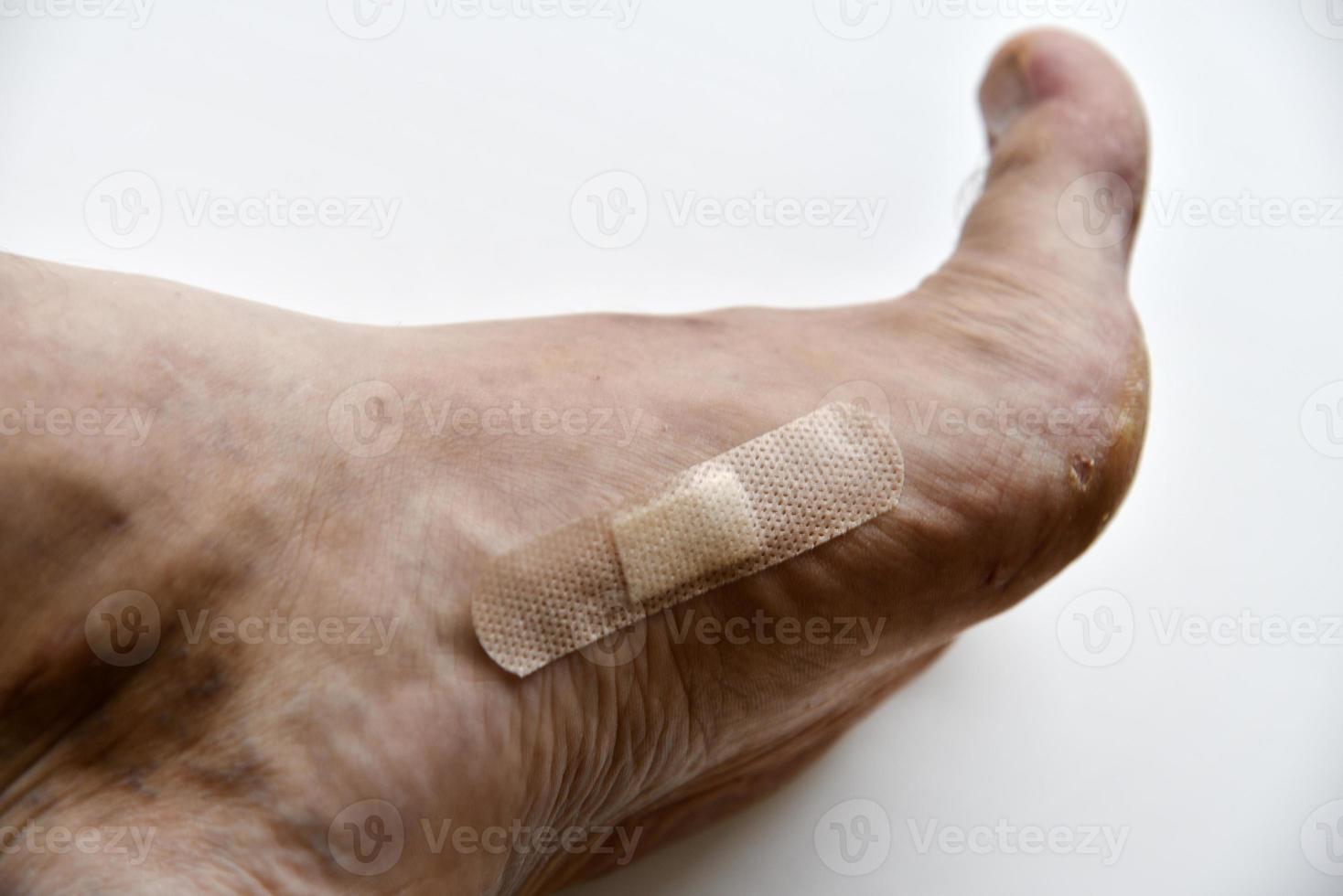 une tache sur la jambe blanche d'un homme. le patch sur la blessure à la jambe est un gros plan. photo