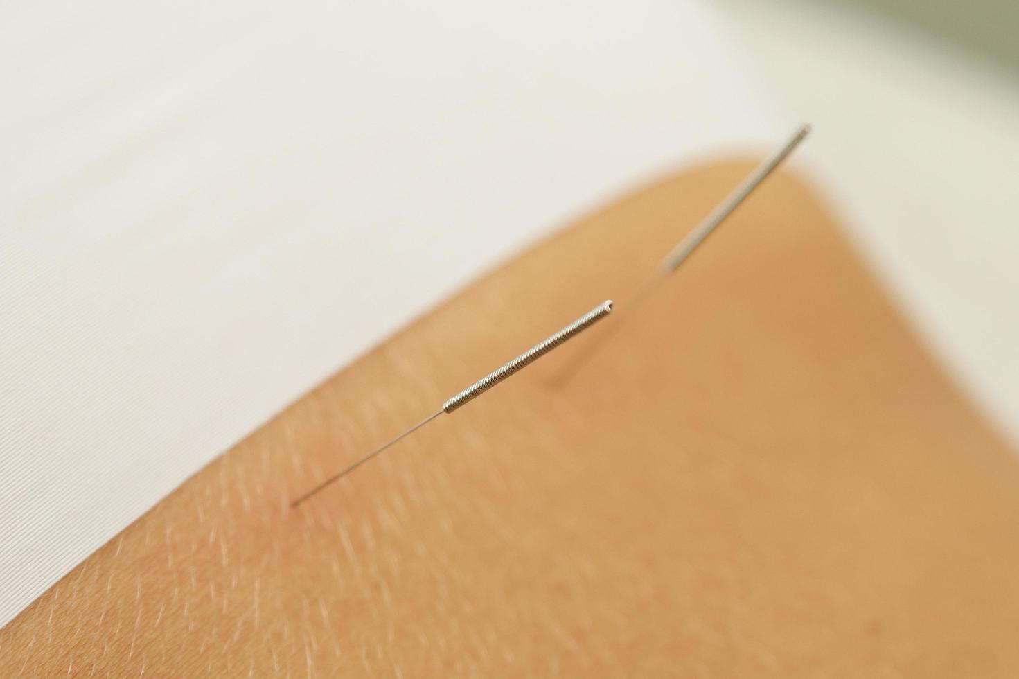 dos féminin avec des aiguilles en acier pendant la procédure de thérapie d'acupuncture photo