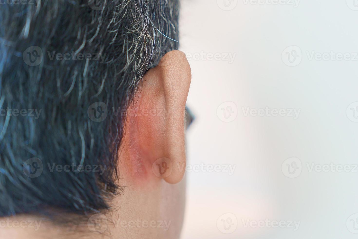 homme ayant des problèmes d'oreille dus à la dermatite séborrhéique, au psoriasis, à la teigne et à une infection cutanée fongique photo